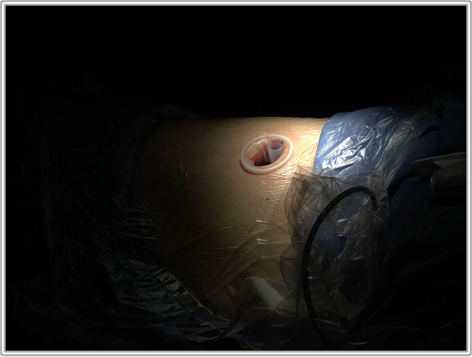 胸腔镜手术使用单孔固定器